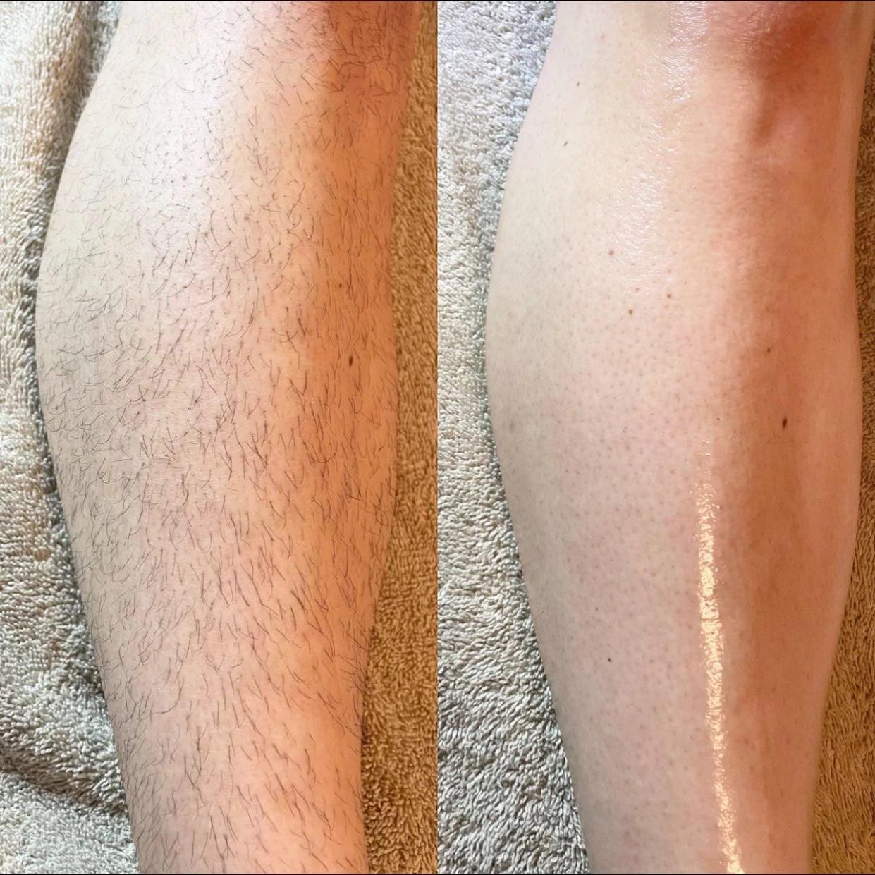Comparison of a leg with hair on one side and bare skin on the other, on a textured surface.